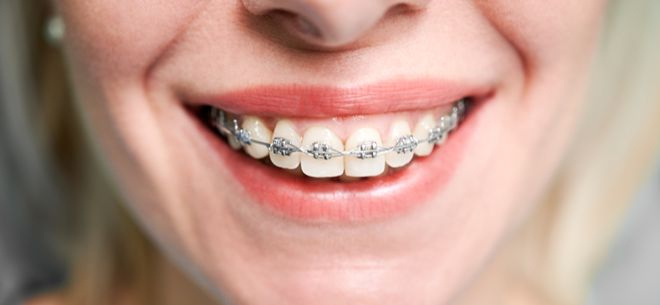 Брекеты в клинике Dental Harmony со ск